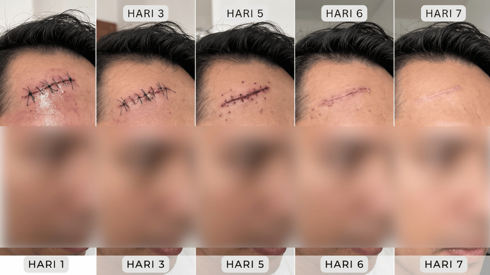 Manfaat Ikan Gabus untuk Luka Jahitan dan Pemulihan Tubuh